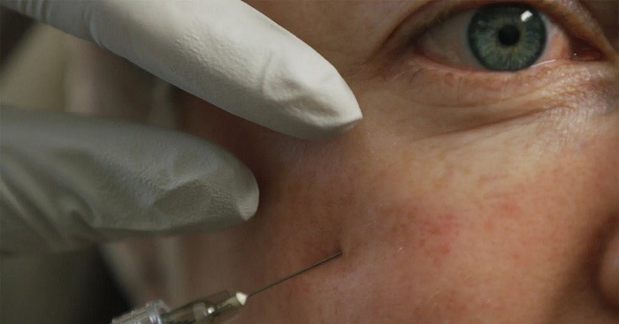 تزریق ژل به ناحیه زیر چشم چگونه انجام می‌شود